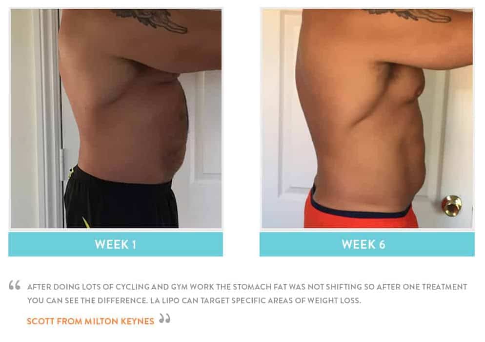 Before & After Stomach Fat Bradford