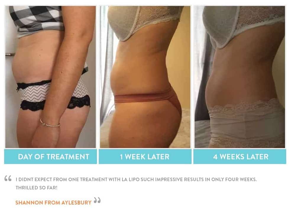 before, Cryolipolysis Bradford