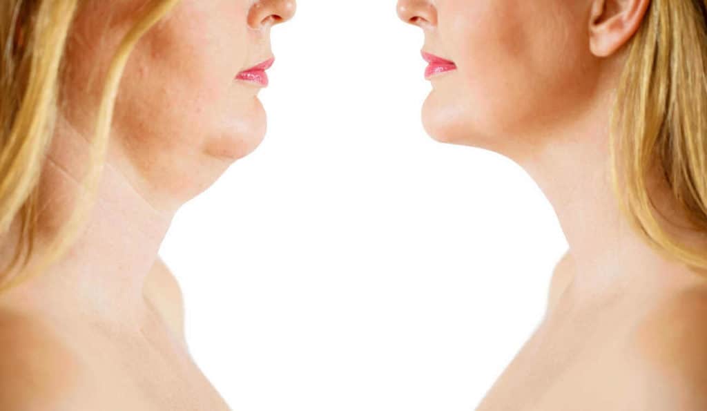 Double Chin treatment Bradford before and after results