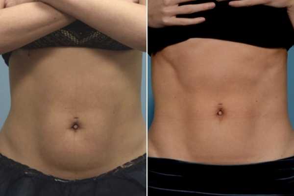 body sculpting FAQs Bradford