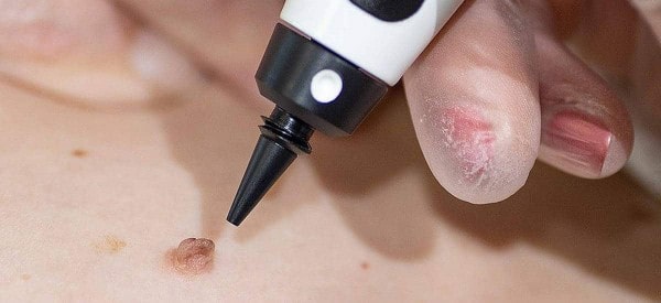 After Skin Tag Removal Bradford