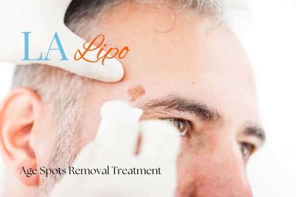 What Are the Most Effective Treatments for Age Spots Bradford?