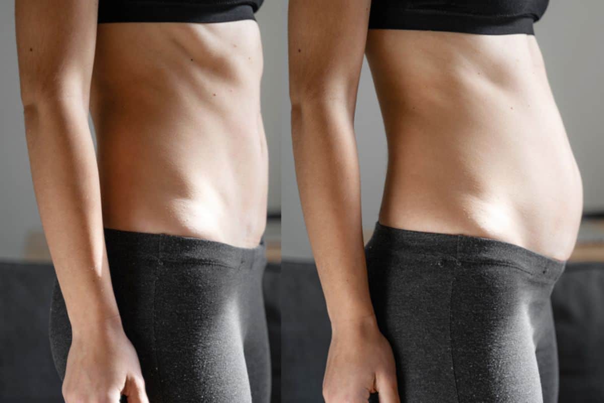 How long does diastasis recti take to improve Bradford?