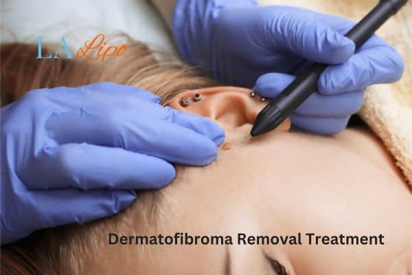 Dermatofibroma Removal Treatment Bradford