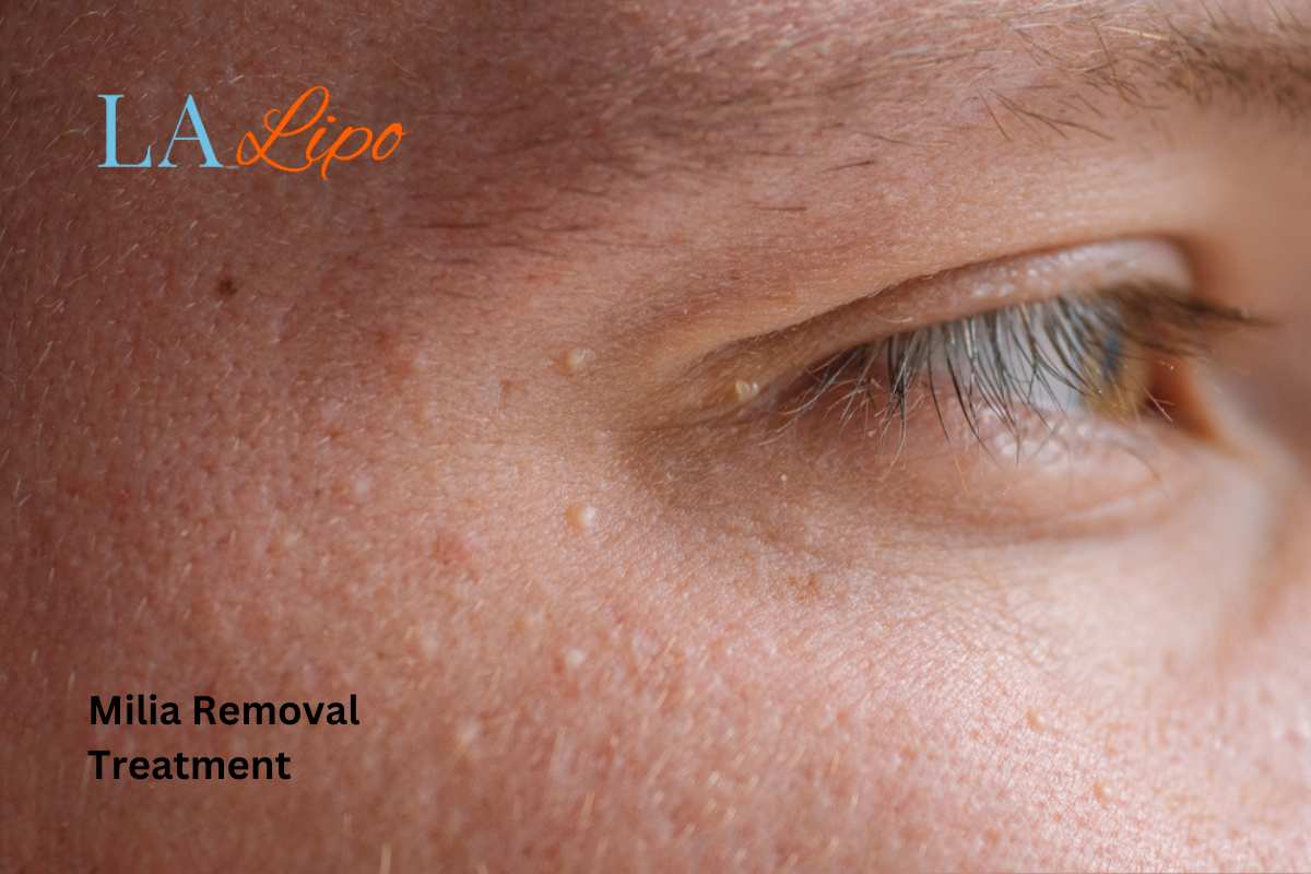 Cryopen Milia Removal: Is It the Easiest and Safest Option Bradford?