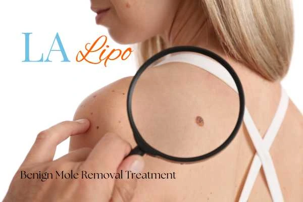 Woman having her inspection of blemish before mole removal Bradford