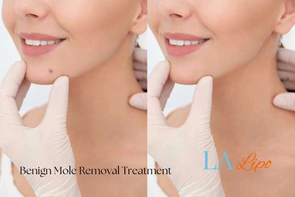 woman's before and after mole removal Bradford results