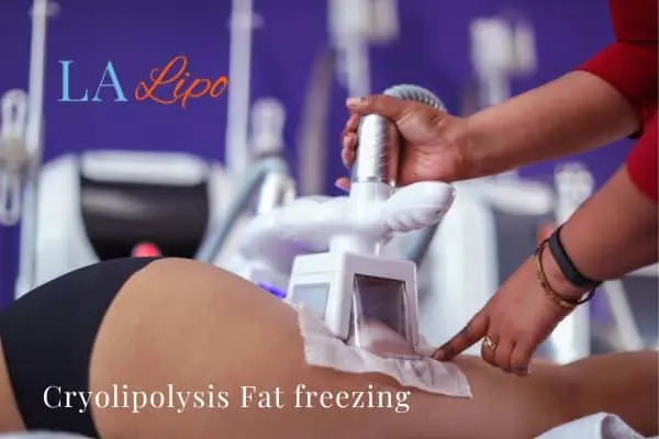 women getting fat freezing Bradford