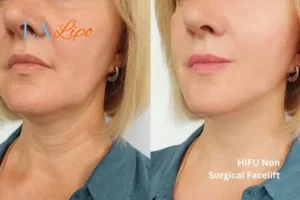 hi-fu for wrinkles Bradford before and after results