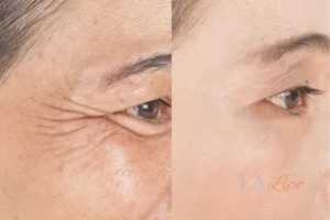 Before and after results of woman - HI-fu wrinkles reduction treatment Bradford