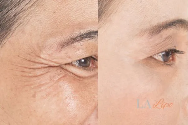 Before and after results of woman - HI-fu wrinkles reduction treatment Bradford