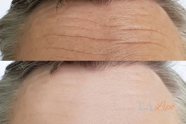 results of HIFU Bradford on mans forehead to help reduce lines and wrinkles