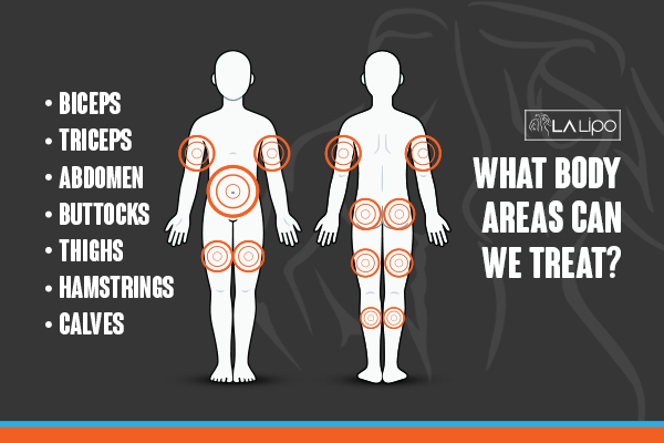 Graphic to show areas you can have LA-EMS Body Sculpting Bradford treatment.