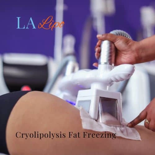 fat freezing - Cryolipolysis Bradford