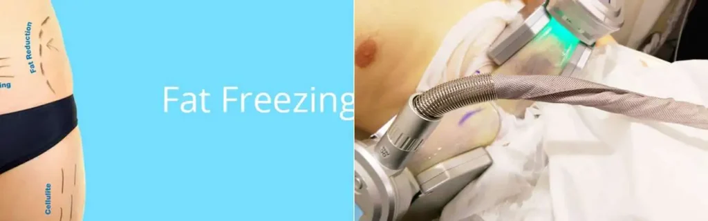 multi areas of a persons body having coolsculpting Bradford treatment