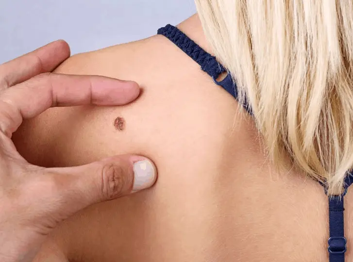 woman having mole removal Bradford consultation before treatment.