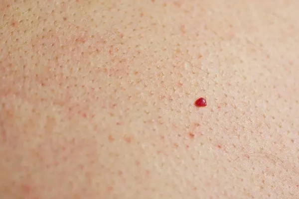 close up of a cherry angioma Bradford