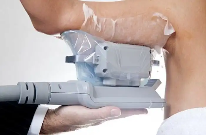 Picture of fat freezing Bradford on the upper arms.