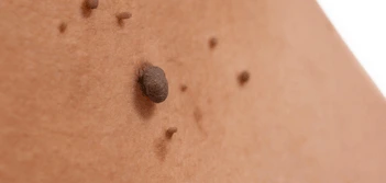image of a skin tag Bradford