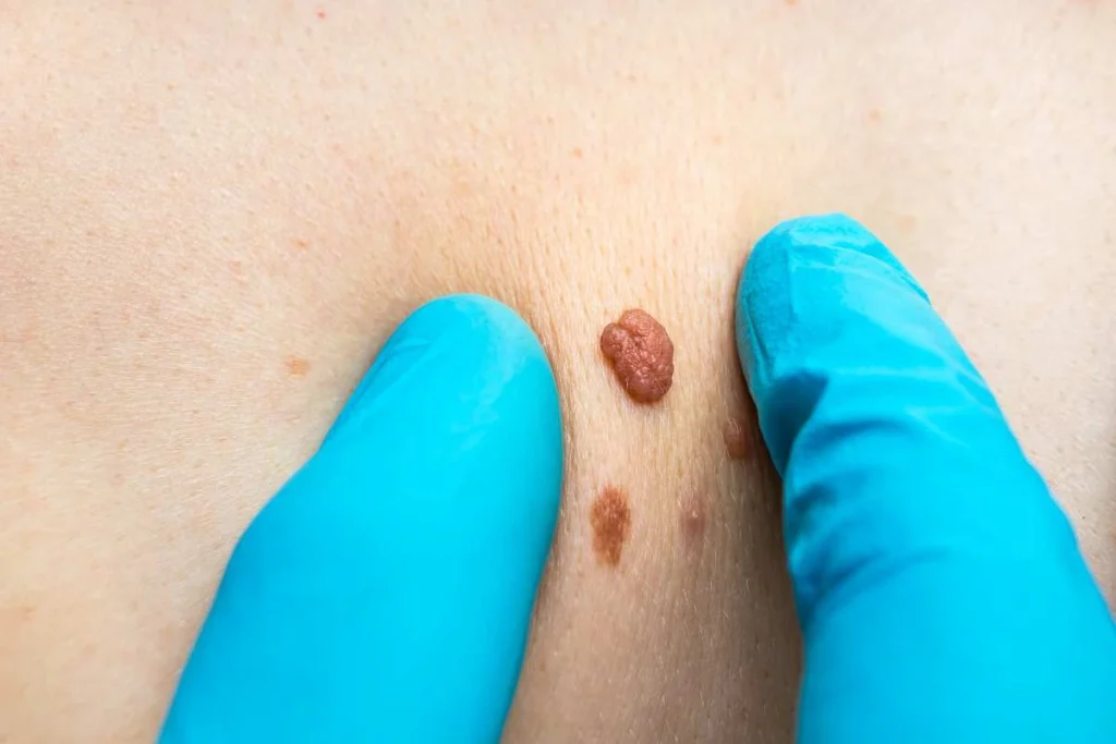 Consultant examining a skin tag Bradford