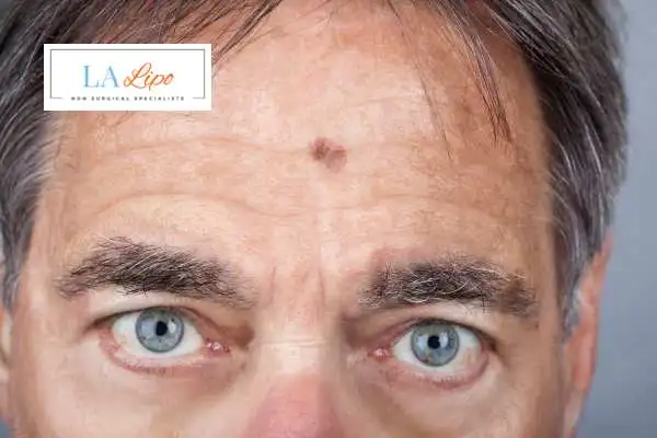 Solar Lentigo Removal Bradford image of man with mark on his forehead