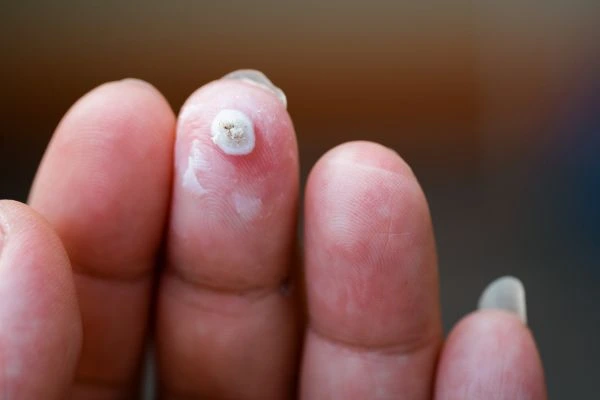 wart on person finger - cryotherapy to treat from LA LIPO Bradford