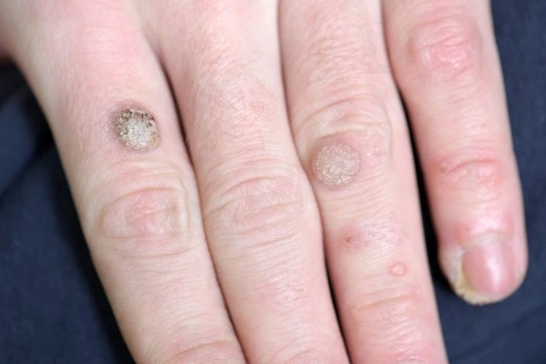 photo of warts on person hand - see wart removal Bradford from LA LIPO
