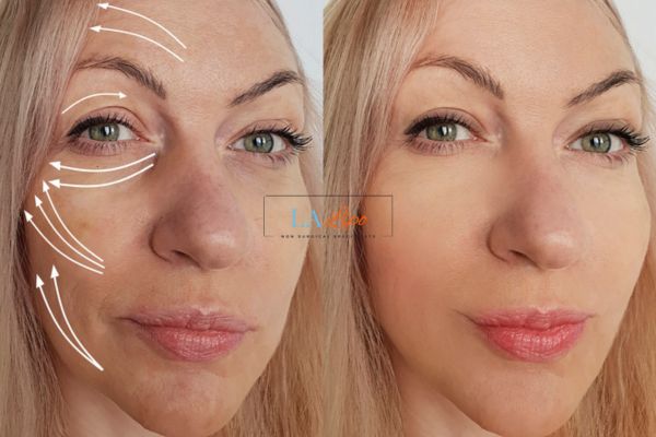 Morpheus 8 results Bradford face lift.