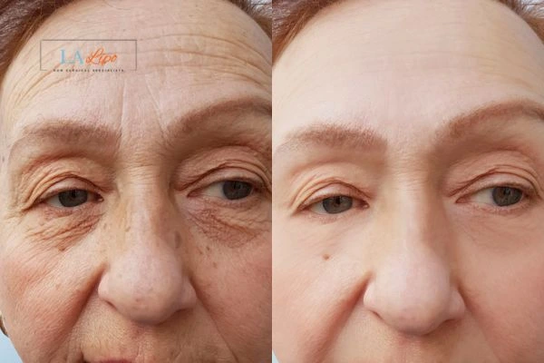 The powerful benefits of Morpheus8 Treatment Bradford - Call Our team today!