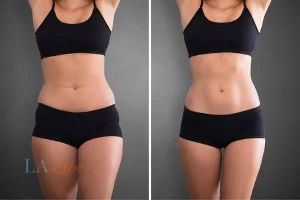 before and after results of non-surgical treatment to help a woman's body image and mental health Bradford