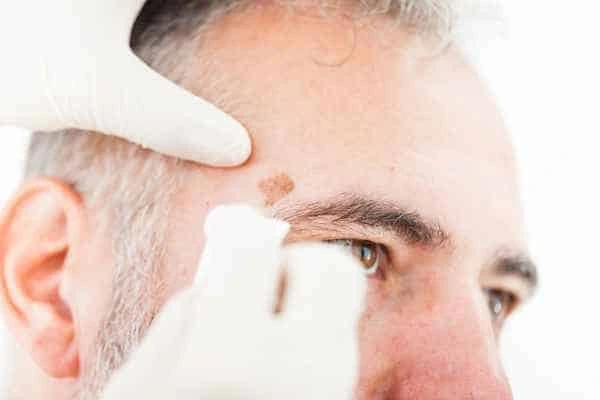 Age spots and elderly people Bradford what is the link?