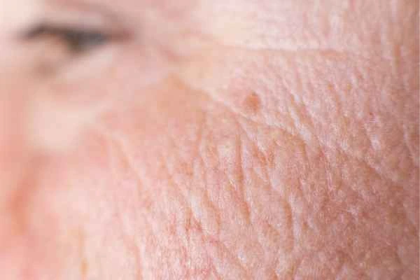 close up picture of a woman's face showing an age spot Bradford