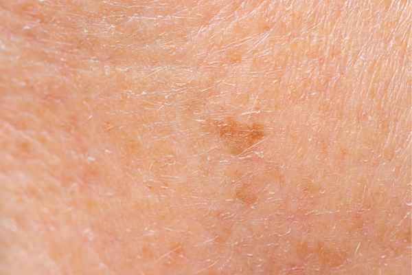 close up picture of age spots Bradford