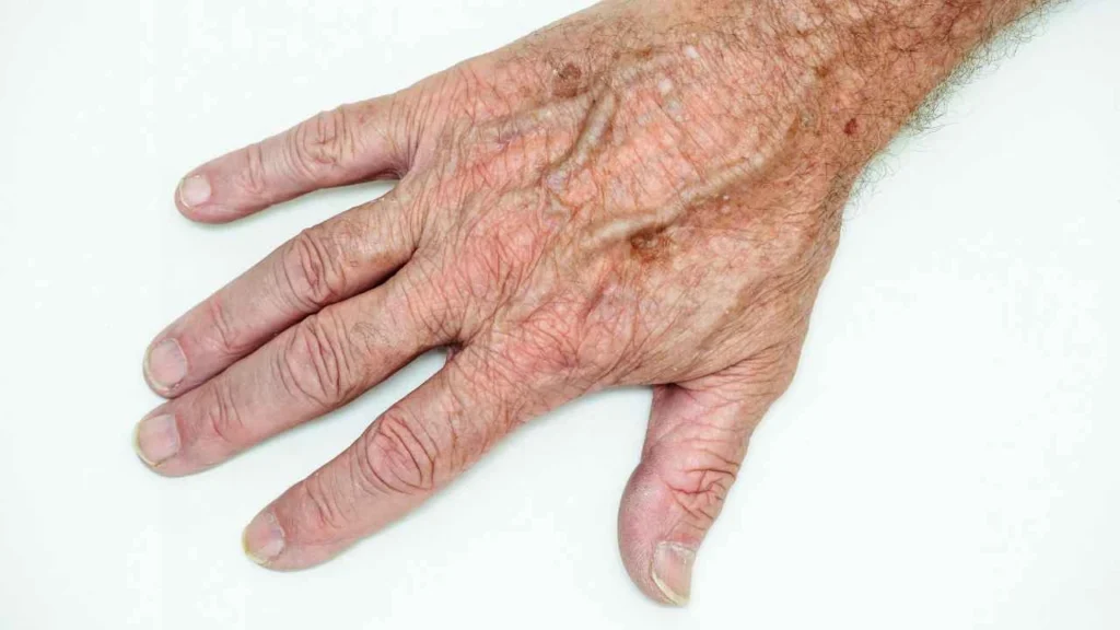 Male hand showing age spot Bradford