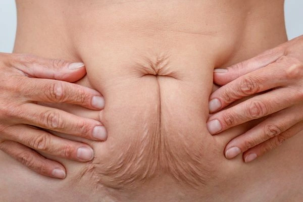 Image of a woman's stomach with loose skin - example of skin tightening Bradford options